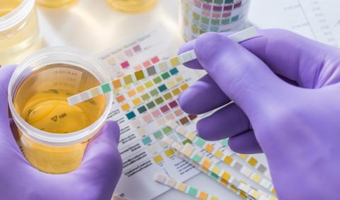 Urine Test or Urinalysis