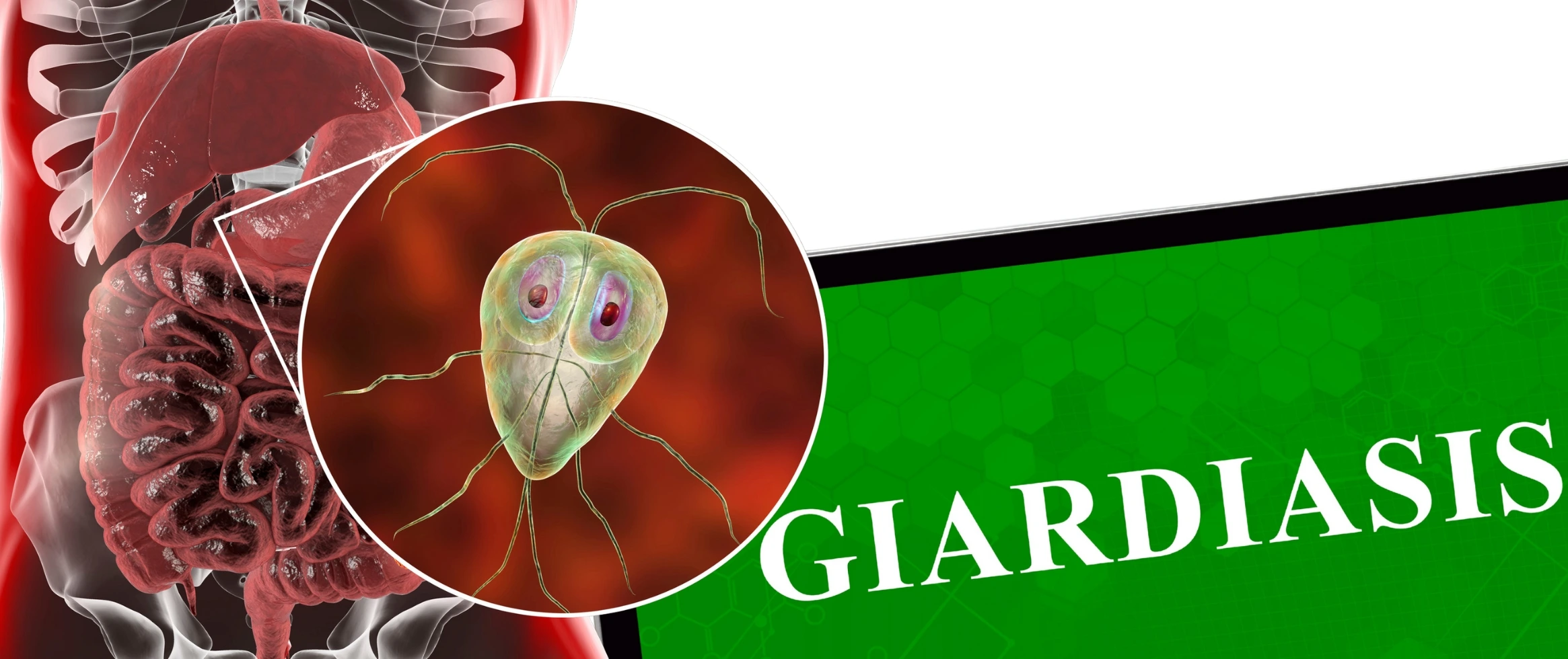 giardiasis