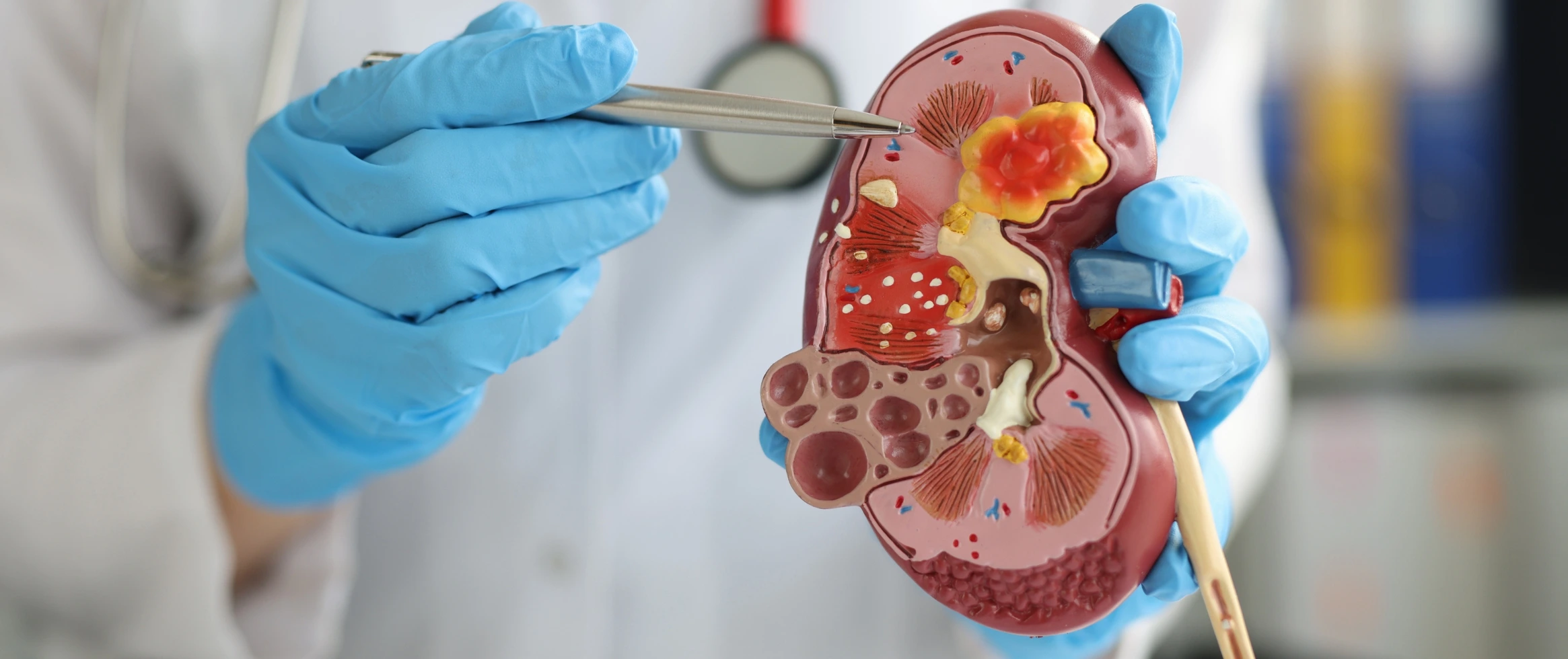 Glomerulonephritis