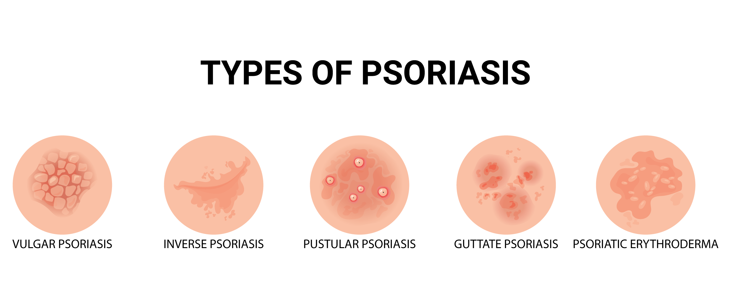 Types of Psoriasis